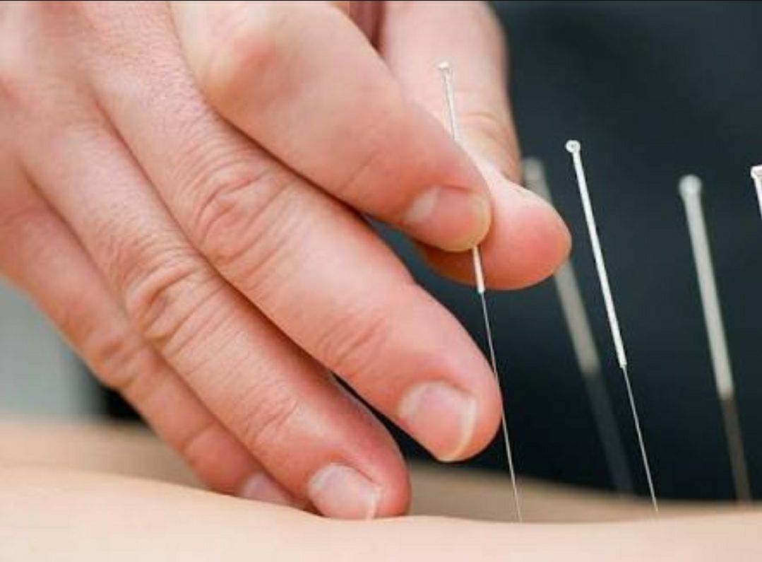 Acupuntura, alternativa contra el dolor - El Latino